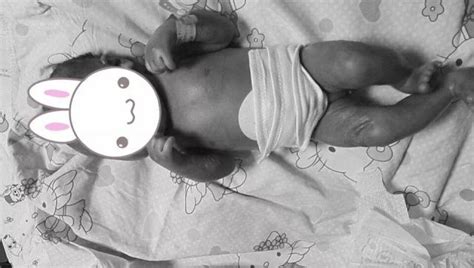 湖南一女婴患罕见病 全身皮肤像覆盖一层透明塑料膜_大湘网_腾讯网