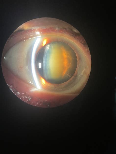 Nuclear with posterior subcapsular cataract : r/Ophthalmology