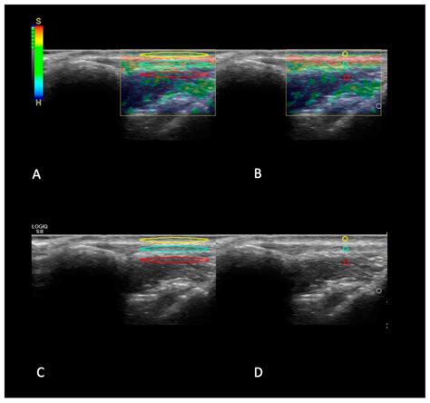 Strain Elastography Evaluation of Patellar Tendons in Dogs after TPLO ...