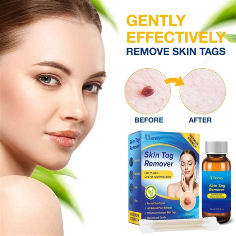 Ulensy Skin Tag Remover - Extra Strength Liquid for Fast, Pain-Free ...
