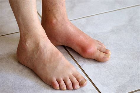 Gout Treatment at Home