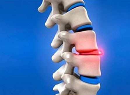 Disc Surgery Faqs - Disc Surgery