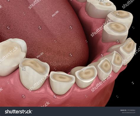 325 Attrition Tooth Images, Stock Photos & Vectors | Shutterstock