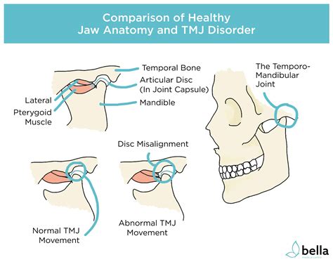 What is TMJ? Symptoms, Causes, and Treatment | Temporomandibular Disorder (TMD) Explained