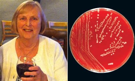 Grandmother dies from sepsis after pet dog licked wound on her leg ...