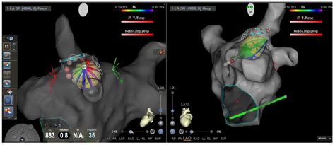 Atrial Fibrillation Ablation with a Novel Fully 3D-Mapping-Integrated ...