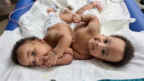 Twins born conjoined celebrate birthday after separation surgery | fox43.com