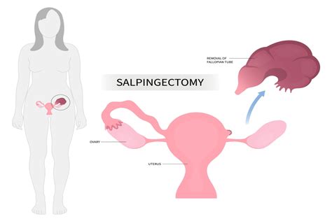 Image result for Fallopian Tube Surgery