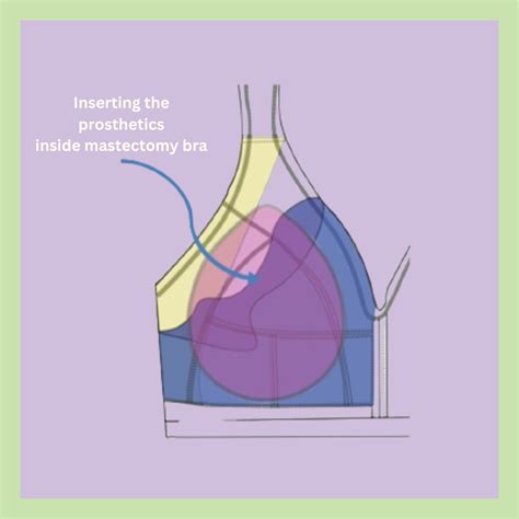 “Mammary” Poly-fill tear drop breast prosthetic - SUGAR SHELL