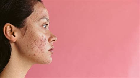 5 Acne Causing Foods to Avoid for Clear Skin | Garnier India