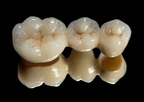 Crown & Bridge Dentistry - Dental Planets