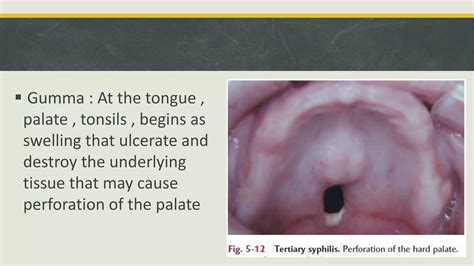 Bacterial Infections of Oral Cavity | PPTX