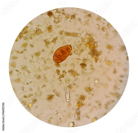 Stool parasites examination test for parasites or eggs in a stool sample with iodine stained ...