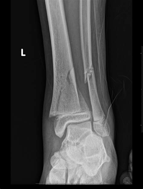 Salter-Harris Fracture | Treatment & Management | Point of Care