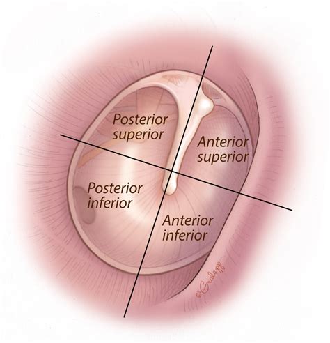 Tympanic Membrane Perforation Repair