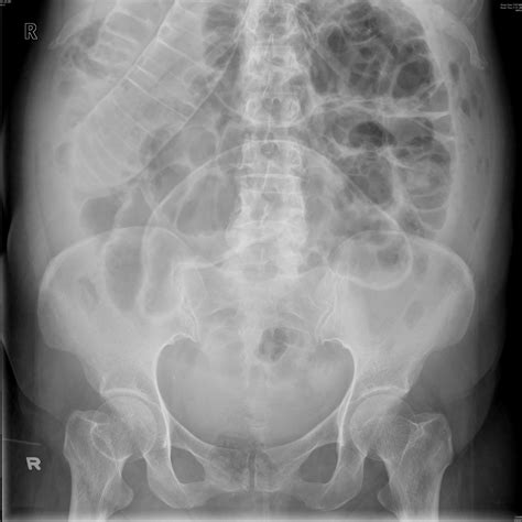 Image result for Normal X-ray