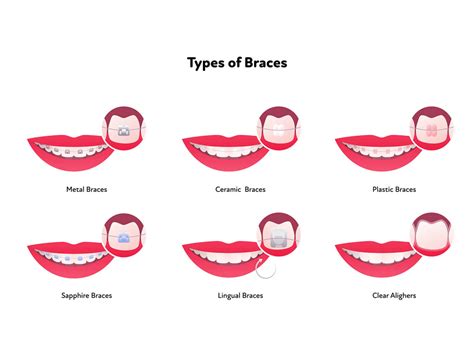 Types of Braces Explained by Calallen Dental & Orthodontics.