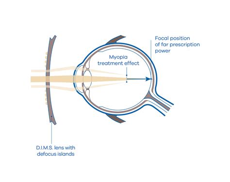 MiYOSMART Lenses | Myopia Management for Children – HOYA Vision