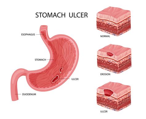 Stomach erosion and ulcer illustration 22632962 Vector Art at Vecteezy