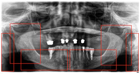 AI-Powered Identification of Osteoporosis in Dental Panoramic ...