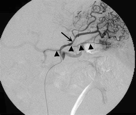 Efficacy of the Left Gastric Artery as a Route for Catheterization of the Right Gastric Artery | AJR