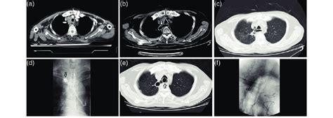Image result for Exploratory Thoracotomy