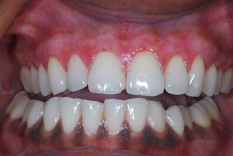 Blog | Dental Implants | Chrysalis Dental Centres Canada
