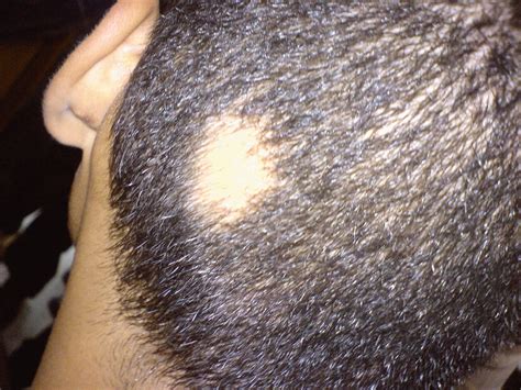 Bald Head Patches