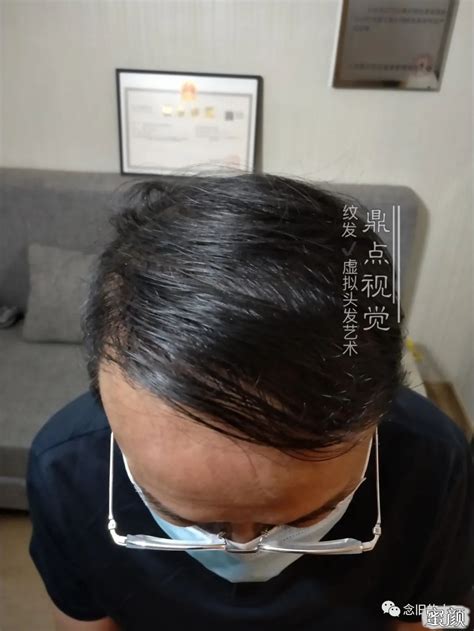 Hair Transplant