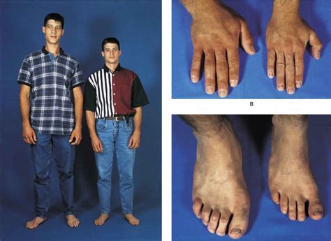 Gigantism causes, symptoms, diagnosis & treatment
