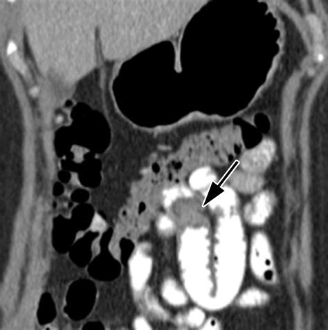 Small Bowel Neoplasms: A Pictorial ReviewRadioGraphics