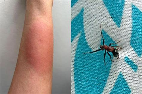 Ant bite stings man's forearm and..., Latest News - The New Paper
