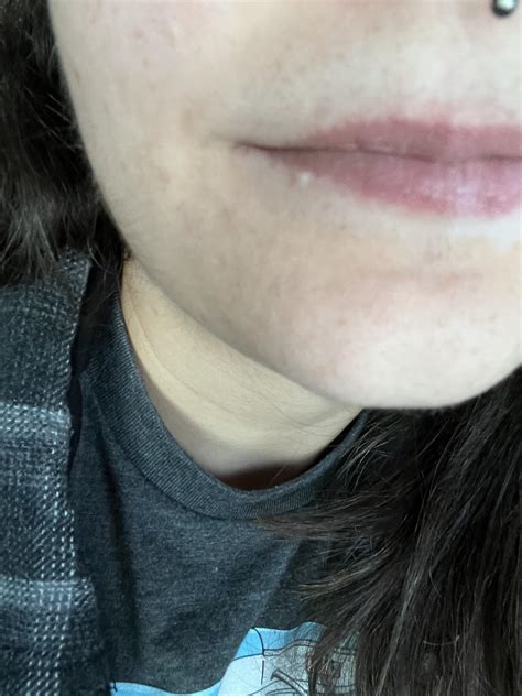 Small bump that looks like a white head on my lip… probably from smoking cigarettes. : r/medical ...