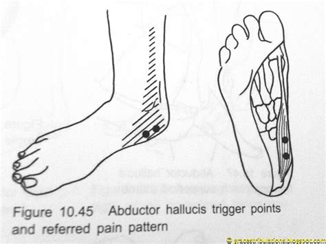 Grace's Tri-bulations: Inner Heel Pain: Trigger Point Therapy