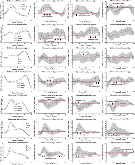 Image result for Lower Extremity EMG Testing