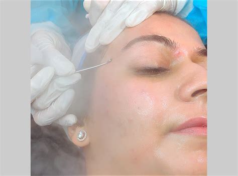Cutis | Comedone Extraction