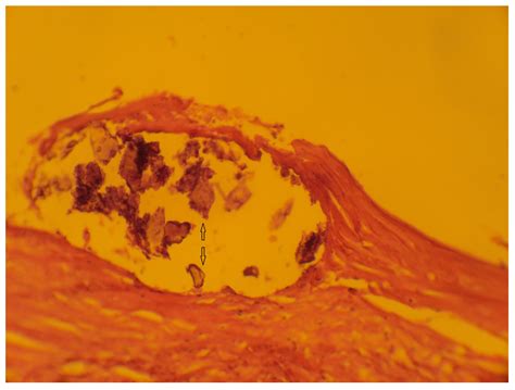 Aortic Aneurysm with and without Dissection and Concomitant ...