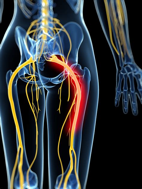 Sciatica in pregnancy: When it's more than the usual aches and pains ...