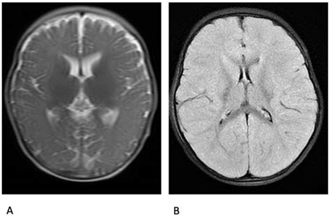 Fatal Status Epilepticus in Dravet Syndrome