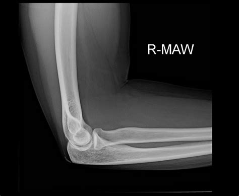OrthoDx: Calcific Tendinitis of the Triceps Tendon - Clinical Advisor