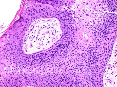 Squamous Cell Carcinoma In Situ Histology Researchers Identify Cheap
