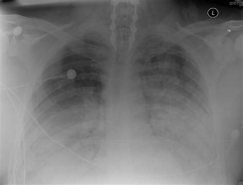 Acute Respiratory Distress Syndrome; Acute Hypoxemic Respiratory ...