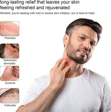 1 Pack Manuka Honey Eczema, Tea Tree Oil, Heat Rash Philippines | Ubuy