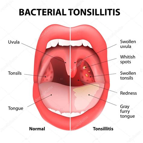 Tonsillitis Bacterial Or Viral