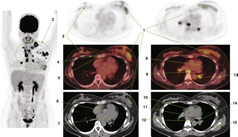 and Anatomy of PET/CT | Radiology Key