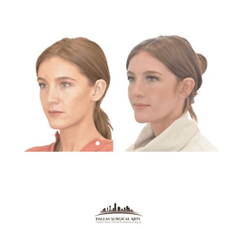 Enhance Your Profile with Genioplasty and Lower Face Contouring Surgery in Dallas