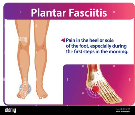 Illustration of foot pain and plantar fasciitis symptoms Stock Vector Image & Art - Alamy