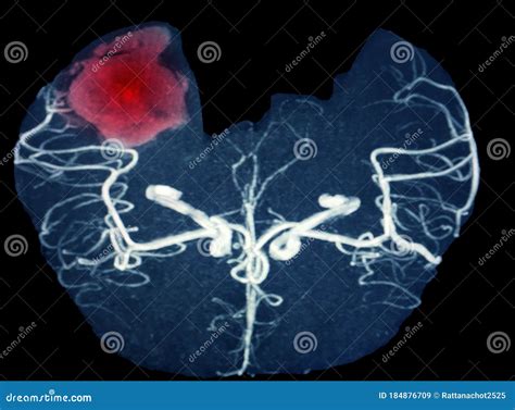 MRA Brain or Magnetic Resonance Angiography Image MRA of Cerebral Artery in the Hemorrhage in ...