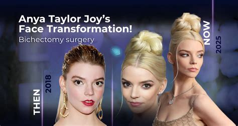 Anya Taylor-Joy’s Plastic Surgery: Exploring the Transformation - Dr. Cengizhan Ekizceli