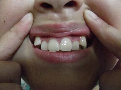 牙齿畸形是有哪些原因造成的？